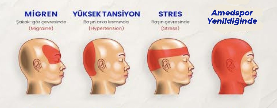 Baş ağrısı türleri