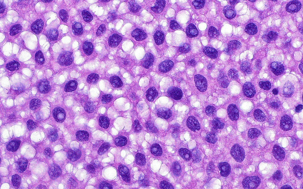 ziad_zaatari's tweet image. 🔬📸 "Polka Dots and Bubbles" 🔵🫧⚪️ ~ Glycogenated cells in a Low Grade Papillary Urothelial Carcinoma ~ #GUpath #Pathology #PathArt