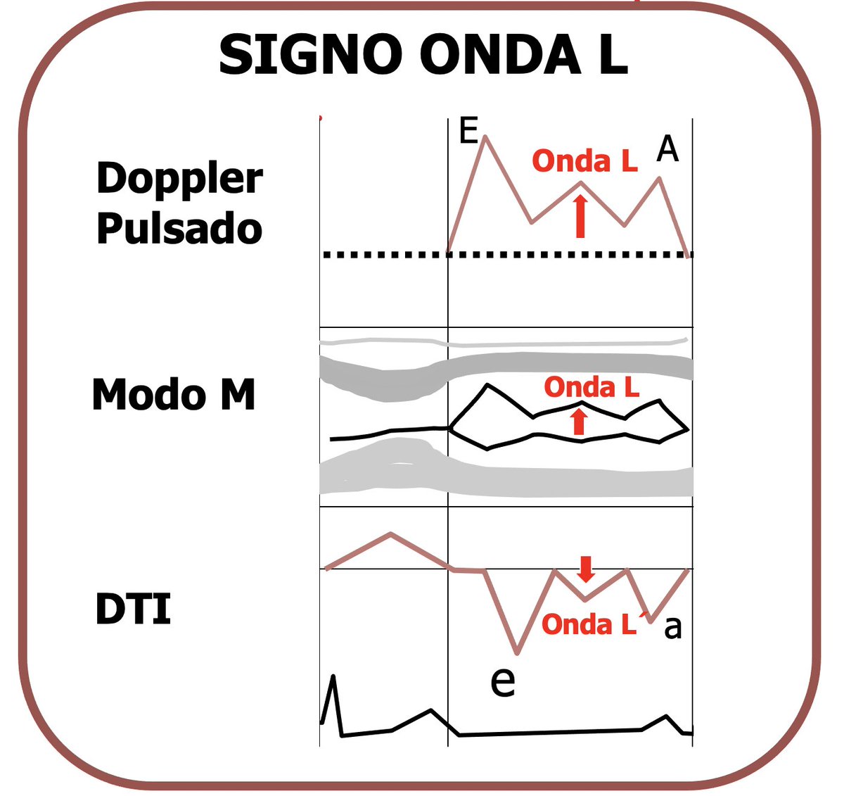 Eco🫀: onda L en flujo transmitral.
🔶️En condiciones normales, el llenado del ventrículo izquierdo ocurre principalmente en dos fases visibles en Doppler mitral:
🔸️Onda E: llenado ventricular temprano pasivo.
🔸️Onda A: llenado por contracción auricular.
🔶️Entre ambas