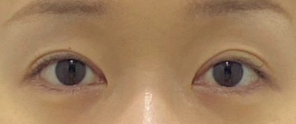 jinseiowatanba's tweet photo. フルリュン美容外科で涙袋フィラーしてきた、安いし、みんな優しくて、ちょっと痛くて涙ポロポロだったけど、可愛い目元になれて大満足！　
#フルリュン美容外科
#韓国整形 https://t.co/6dmBHQYhx8