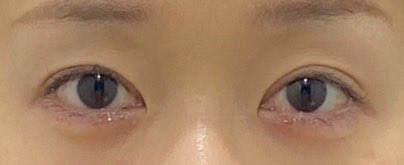 jinseiowatanba's tweet photo. フルリュン美容外科で涙袋フィラーしてきた、安いし、みんな優しくて、ちょっと痛くて涙ポロポロだったけど、可愛い目元になれて大満足！　
#フルリュン美容外科
#韓国整形 https://t.co/6dmBHQYhx8