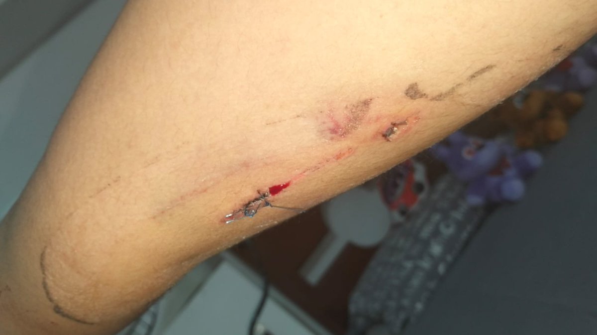 me corté el brazito en la chamba