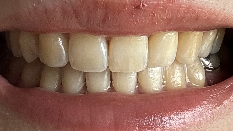 Lie1847737's tweet photo. オフィスホワイトニング1回目
Before - After 

あんまりわかんないけどくすみがなくなった！でも前歯のエナメル質のヒビが目立つようになりました🥹 歯の傾きのせい？で、正中ズレてるように見える🤔

マウスピース矯正歯科(通ってたとこではない)で13,500円でした💸 https://t.co/DMzxHfVLkk