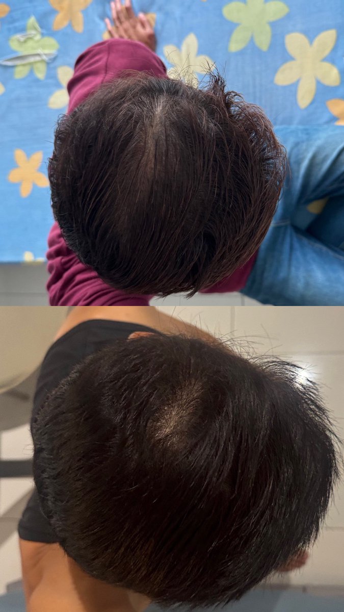 Baik perempuan or lelaki, hair care rountine mmng paling penting. I mean mesti everyone nak rambut nampak lebat and tak gugur kan? As someone yg rambut dia mmng nipis, aku sarankan this product

Below product im currently using 👇🏼