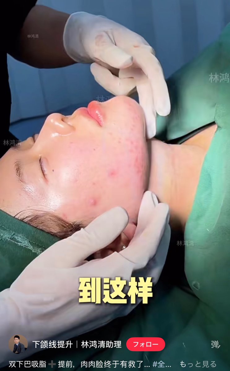 顎下の肉がなくなるだけで、こんなに垢抜けるん？輪郭がはっきりするだけで、横顔の美人度が全然違う。私もこうなりたい。