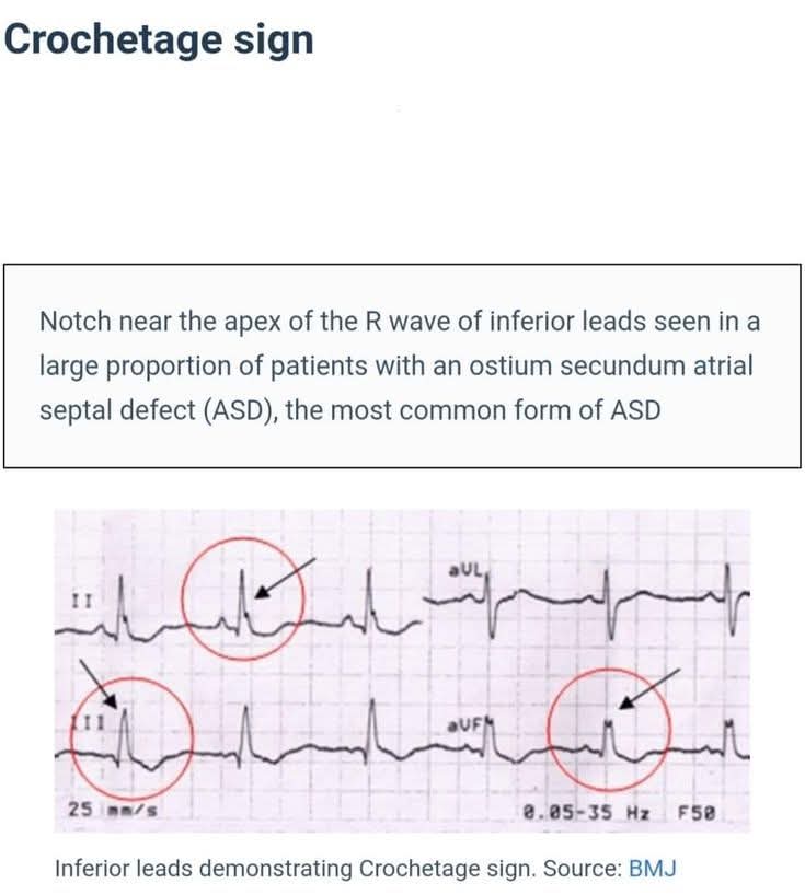 The Crochetage sign &amp; ostium secundum ASD.

● Crochetage sign = Notching of the R wave at the apex of the R wave in the inferior leads on ECG.
● Seen in leads II, III, and aVF
● The notch resembles a “crochet hook”, which is why it is called crochetage (French for crochet).