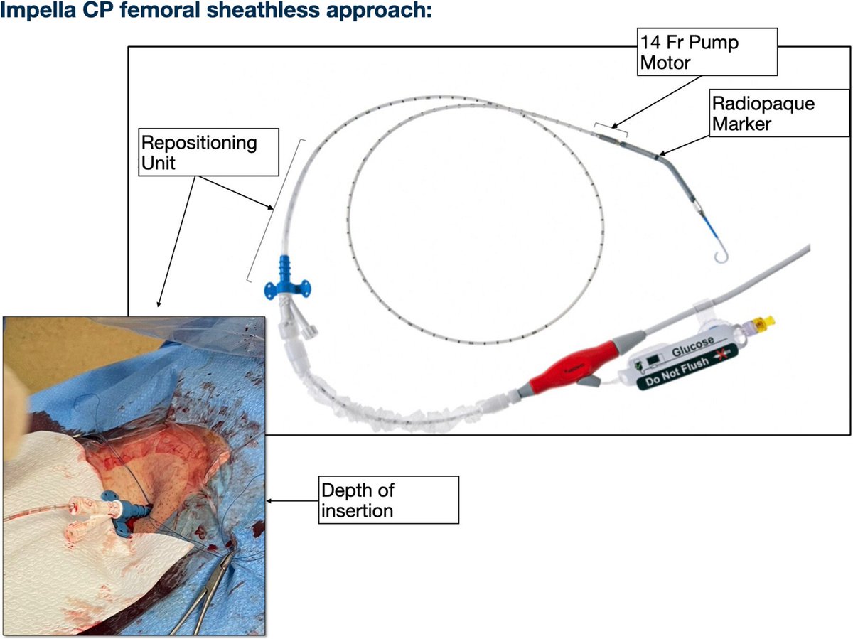 gbiondizoccai's tweet photo. Femoral sheathless Impella implantation: feasible, safe and useful to reduce vascular complications, particularly in patients with small-caliber femoral arteries or increased bleeding risk https://t.co/WtVXVqOMyA @ccijournal https://t.co/1jzOttqd1E