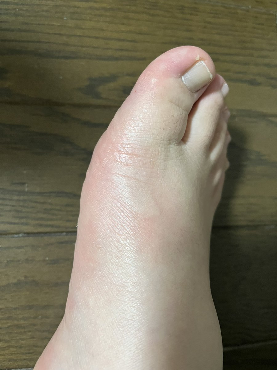 ちょっと汚いので見たい人は自己責任で。

我が家のまな板、ちょっといいやつなんだけど、重たくてさ……
手を滑らせて足の上に落としました。
ちゃんと角が刺さりました:( ;´꒳`;):ﾋｨｨ

今はこの2倍くらい腫れてます。

多分歩けるから骨は大丈夫

ほんとに何かに呪われてる？？