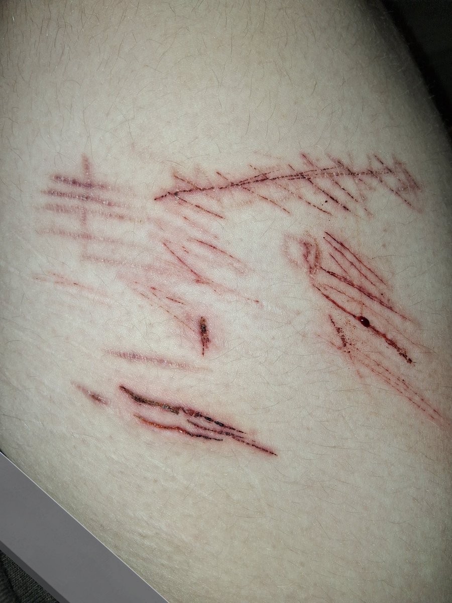 Makaila2810101's tweet photo. All my cuts and scars (in pics instead of the vid i recently posted.) a small thread.
.
..
.
.
.
.
.
.
.
.
.
.
.
.
.
.
#shtwt #redink #scars #styrostwt
#catscratches https://t.co/4FF75A6GxK