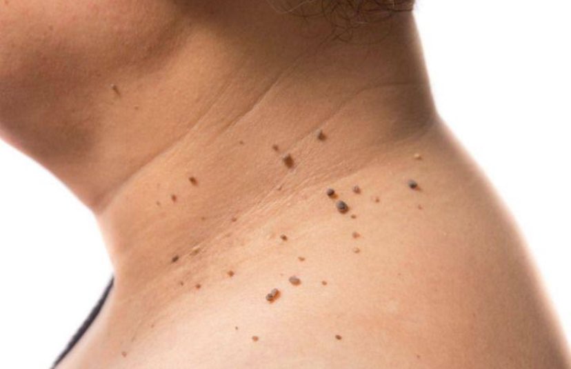 Doktorların asla test etmediği en tehlikeli sağlık sorunu:

Yüksek kortizol.

Sessizce yağlanmaya, hormonal dengesizliklere ve kalp hastalıklarına yol açar.

İşte bir doktor gibi sorunu çözmenin 8 yolu:

1. Ciltte ben olup olmadığını kontrol edin.