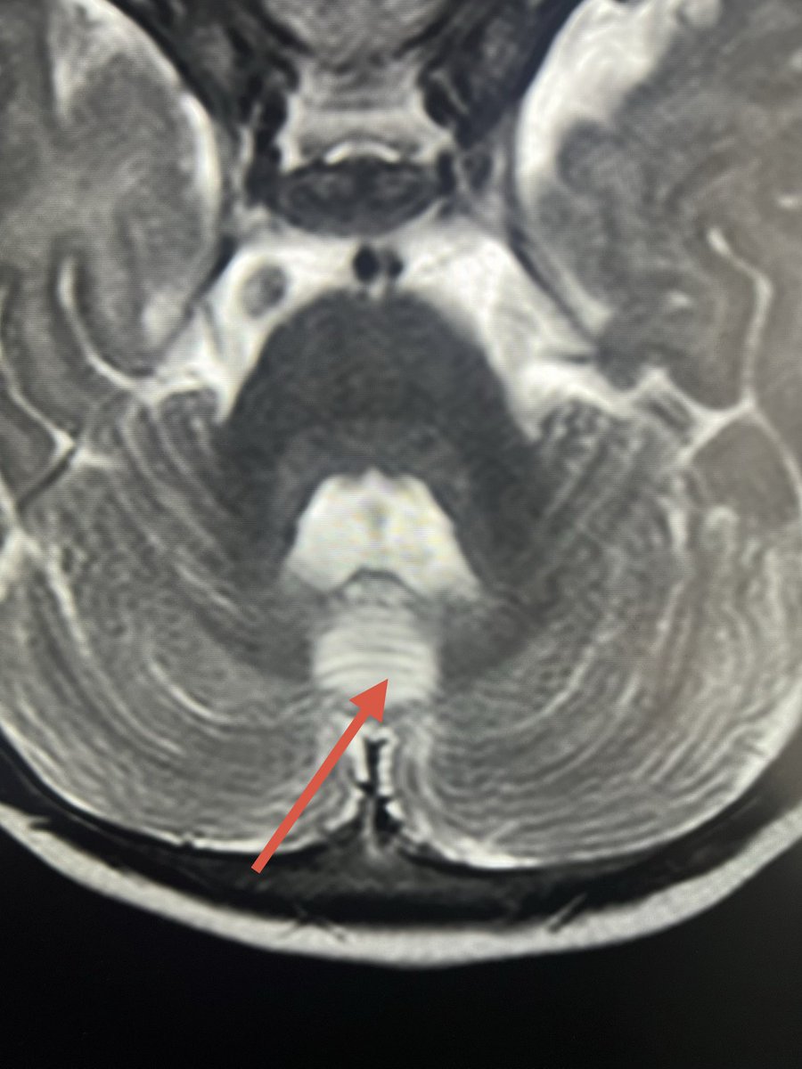 drmankad's tweet photo. The weekend tip 💡: The lesser known sign of perinatal hypoxic ischemic injury- cerebellar vermian injury. Typically focal and rounded patch of gliosis picked remotely. 

This weekend, stay attentive to detail. https://t.co/gZNejebVja