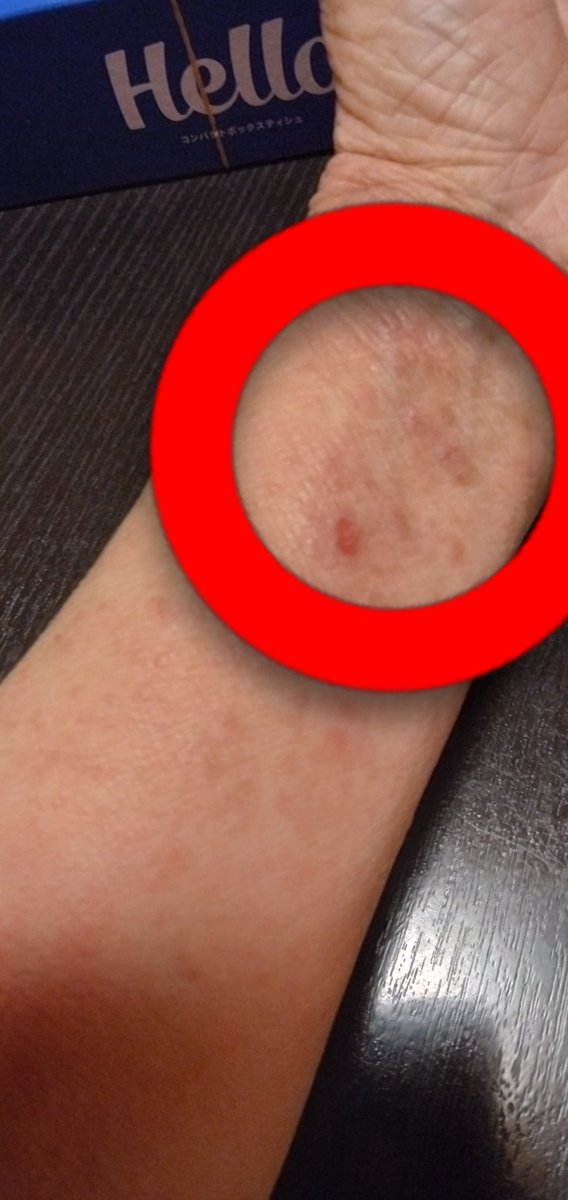 Mayumi_Maruta's tweet image. 電磁波兵器で遠隔から顔を描く加害者側。#アトピー性皮膚炎　#アトピー　#皮膚　#肌　#マイクロ波
izimewadame.muragon.com