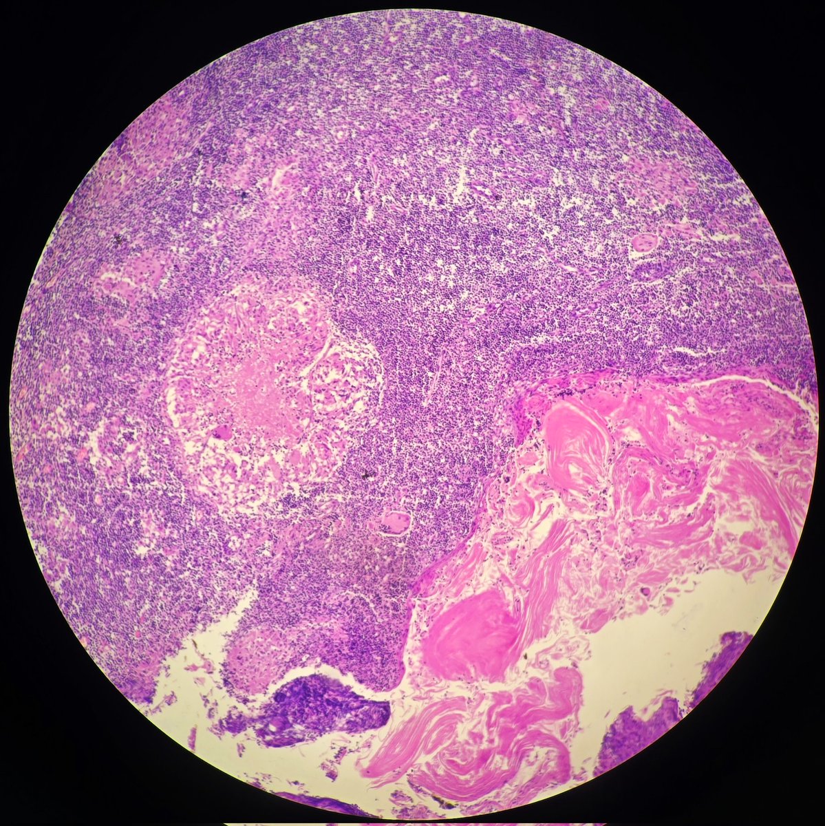 SyedSal55391459's tweet photo. #histopathology
#tonsil
#pathX
#pathTwitter
Tissue from tonsil ( biopsy).
Section shows epithelioid granuloma with caseation necrosis, compatible with tuberculosis. https://t.co/XGhVLpVxwi