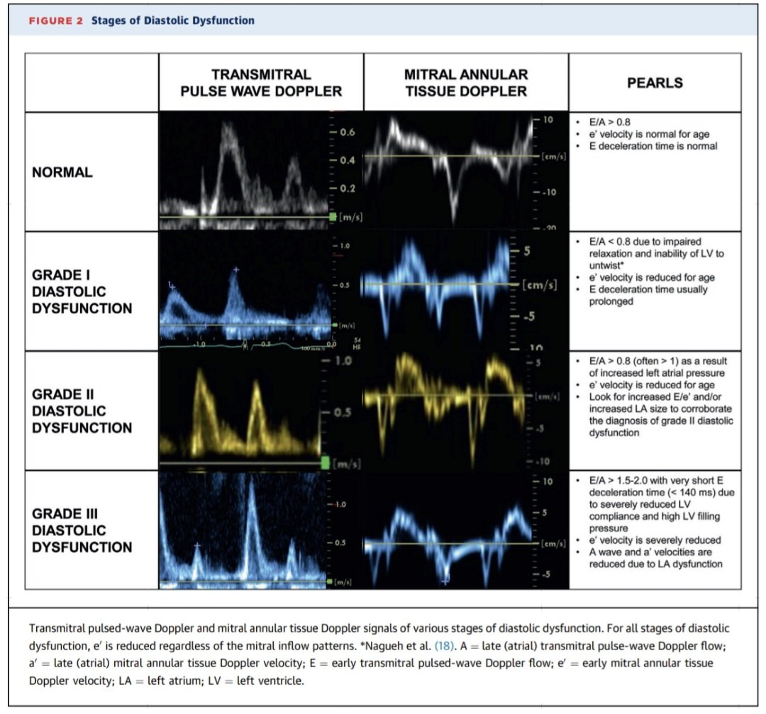 Componentes de la diástole normal y trastornos que pueden afectarlos. 🫀💢😮‍💨
🔷️La diástole comienza en la sístole como energía almacenada en la titina dentro del miocito y como torsión en las fibras intersticiales del miocardio.
🔷️Al finalizar la sístole se produce un