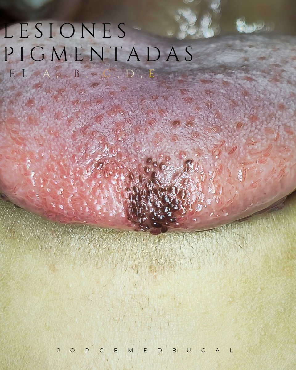 ¿Qué características evaluamos de las lesiones pigmentadas en cavidad oral? 🔎 👄

Así como en piel, en mucosa es importante la evaluación de lesiones que causen cambios de coloración o pigmentaciones inusuales.