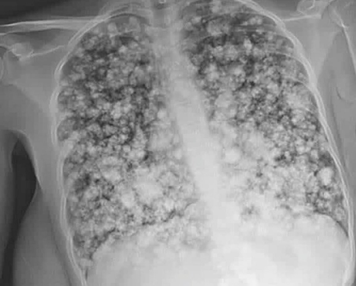 Gençler arasında çok yaygın olan PUF içmeye bağlı Akciğerde gelişen, yaygın, bilateral, diffüz infiltratif bir akciğer tablosu.
Puf masum değil; hatta sigaradan bile daha tehlikeli olabilir. 
Gençleri uzak tutun