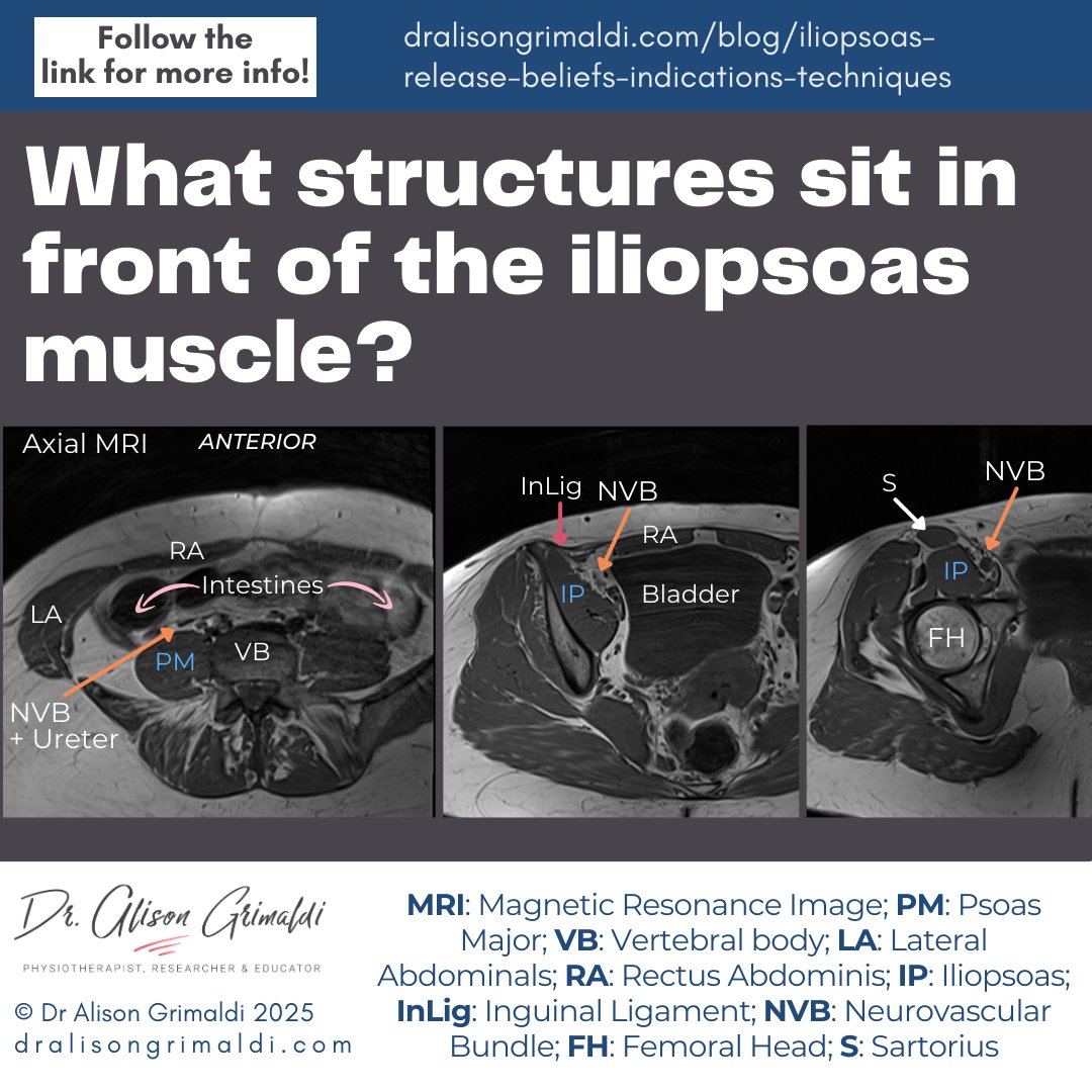 alisongrimaldi's tweet photo. 🤔 What sits in front of the iliopsoas?
Check the key structures &amp; learn more about iliopsoas release — beliefs, indications &amp; techniques:
👉 https://t.co/avbS82CgHg
#HipPhysio #Iliopsoas #PhysioTips #ManualTherapy https://t.co/3URp1hSxeA