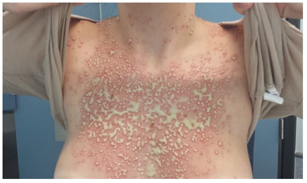 AtualizadoSaber's tweet photo. 🩺 Uma mulher de 29 anos de idade apresentou-se ao departamento de emergência de um hospital exibindo extensa pustulose folicular cutânea com eritema circundante, distribuída pelo pescoço, ombros e parte superior do tronco.

O rosto, braços e parte inferior do corpo foram poupadas.

Regiões do peito não expostas ao sol (como as regiões das mamas protegidas pelo sutiã) permaneceram livres de lesões.

Essas lesões não coçavam, eram indolores e emergiram dentro de 2 dias após a primeira exposição solar da paciente no ano, mesmo com o uso de protetor solar.

O número de pústulas e a área afetada do corpo eram proporcionais à duração da exposição solar.

Nenhum outro sintoma significativo foi identificado.

Nenhum medicamento ou cosmético foi usado.

🔸️Foto da erupção sobre o peito da paciente: