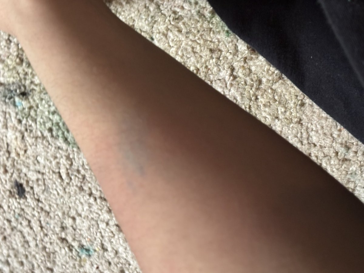 S1mpleSurv1val's tweet photo. ☆ Ignore the awful angle, my fat ass arm, and my dirty floor pls but i hit myself so hard it immediately turned blue like 10x brighter and bluer than in the pictures and thats never happened before is that normal..

#shtwt #bruisetwt #edtwt #shedtwt https://t.co/8UpYDO20lM