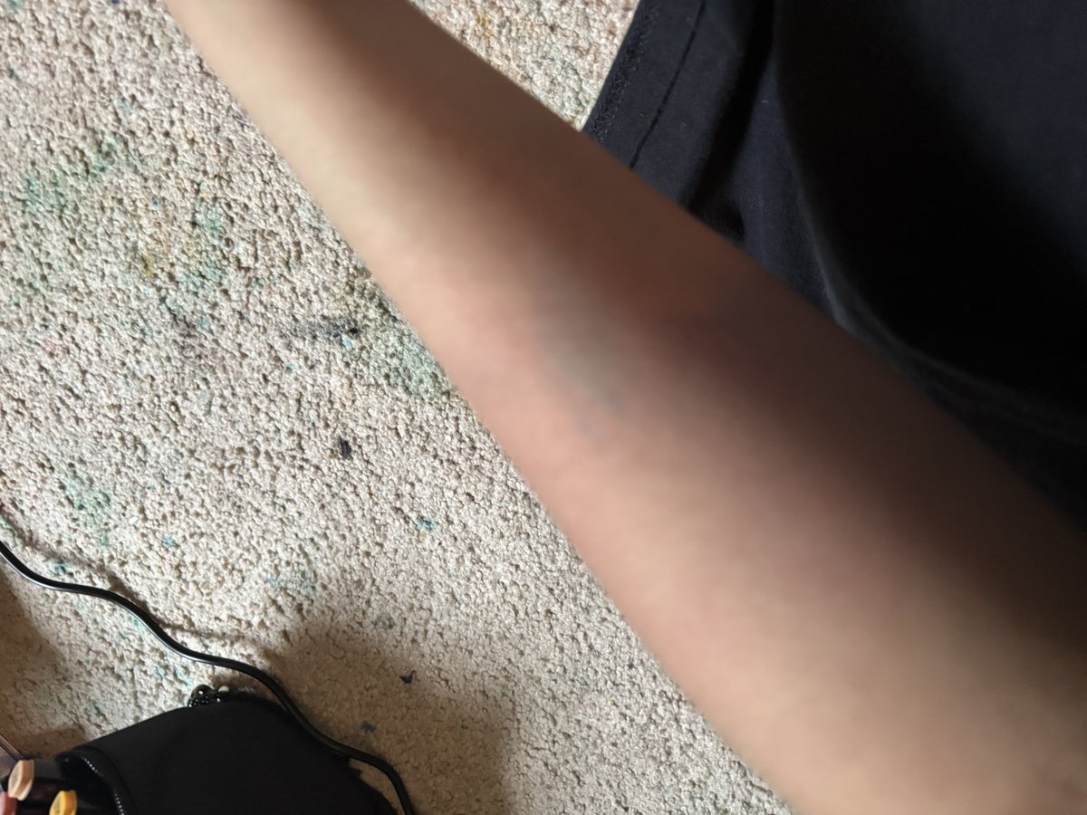 S1mpleSurv1val's tweet photo. ☆ Ignore the awful angle, my fat ass arm, and my dirty floor pls but i hit myself so hard it immediately turned blue like 10x brighter and bluer than in the pictures and thats never happened before is that normal..

#shtwt #bruisetwt #edtwt #shedtwt https://t.co/8UpYDO20lM
