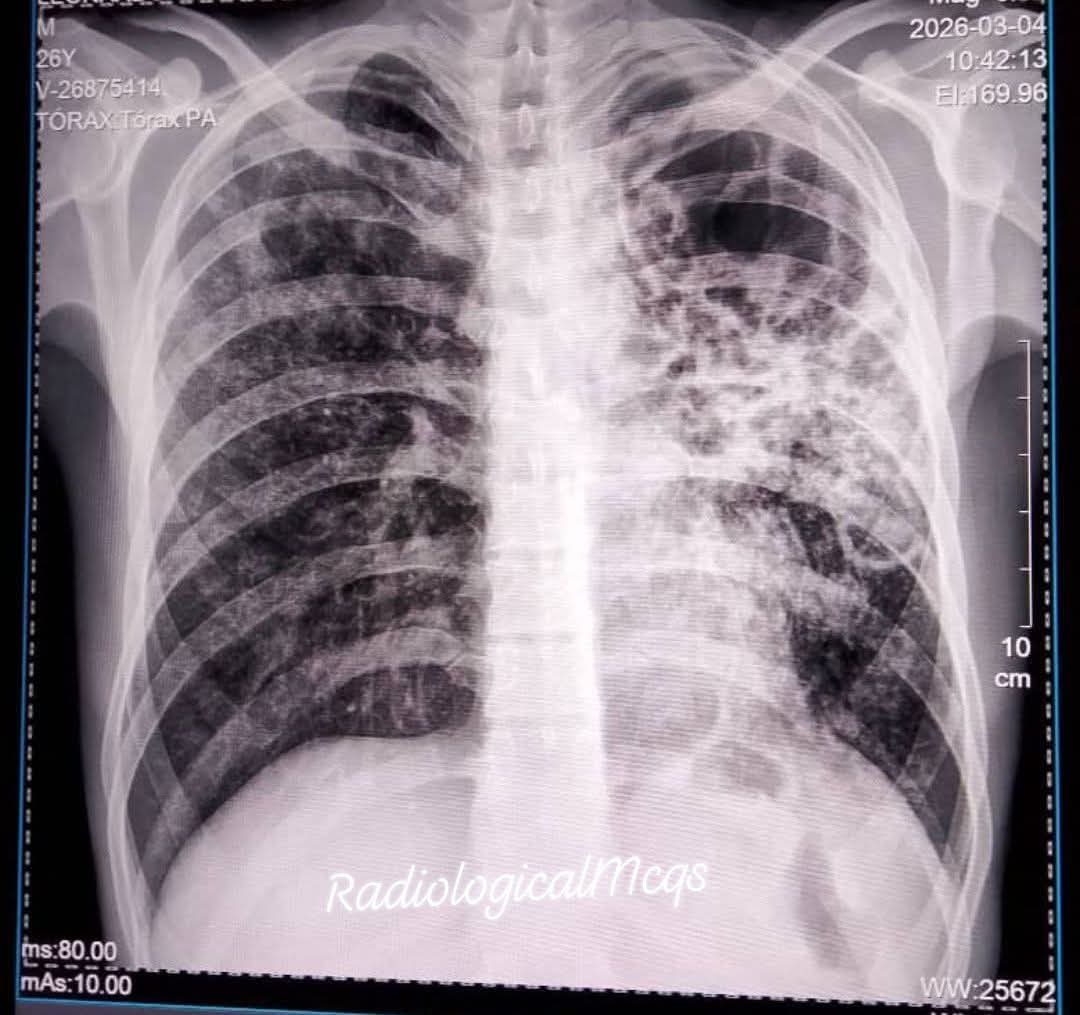 albertoortegana's tweet image. 26-year-old male presents with chronic cough, fever, weight loss, and occasional hemoptysis for the past 2 months. A chest X-ray (PA view) is performed.what are the findings and diagnosis?
#xray #pulmonologist #respiratory #wellness #radiology #health 
@Dr_Shiv_kumar_ @DrAkhilX
