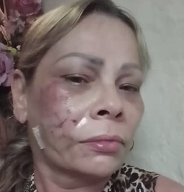 NinoskaPerezC's tweet photo. Para un régimen que esta en quiebra total, sin aliados y tratando de sobrevivir, la represión no es algo que estén considerando descartar. Como buenos farsantes inundan las redes celebrando el #DiaDeLaMujer, no así para #MarianelaPeñaCobas golpeada y arrestada por protestar por los apagones y las pésimas condiciones en Camagüey fue golpeada y arrestada. Aquí muestra las secuelas tras su liberación. #Cuba