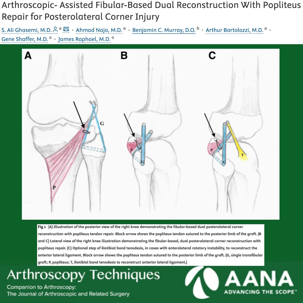 ArthroscopyJ's tweet photo. Check out this novel technique aiming to restore both the static and dynamic stabilizers of the PLC! Video in the link below.
 https://t.co/TWvG3oWsGG
 #PosterolateralCorner #SportsMedicine #PopliteusRepair https://t.co/EZw8Ha5uPx