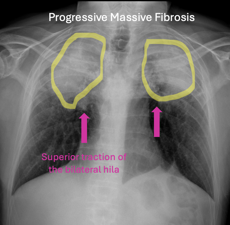 🫁 Answer: Progressive Massive Fibrosis (PMF) in the setting of coal ...