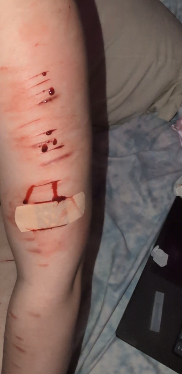 bigdicksusie's tweet photo. before and after
(I forgot to drop it before editing ToT)
don't kill me I'm new to this editing software...
!!ALL FAKE SFX MAKEUP!!
#shedtwt #shtwt #sh #selfharm #cuttwt #slittwt #styrostwt #styro #styros #blood #blooddrip #trulygreg #ignorethatlastone https://t.co/OZzjOv3FE0