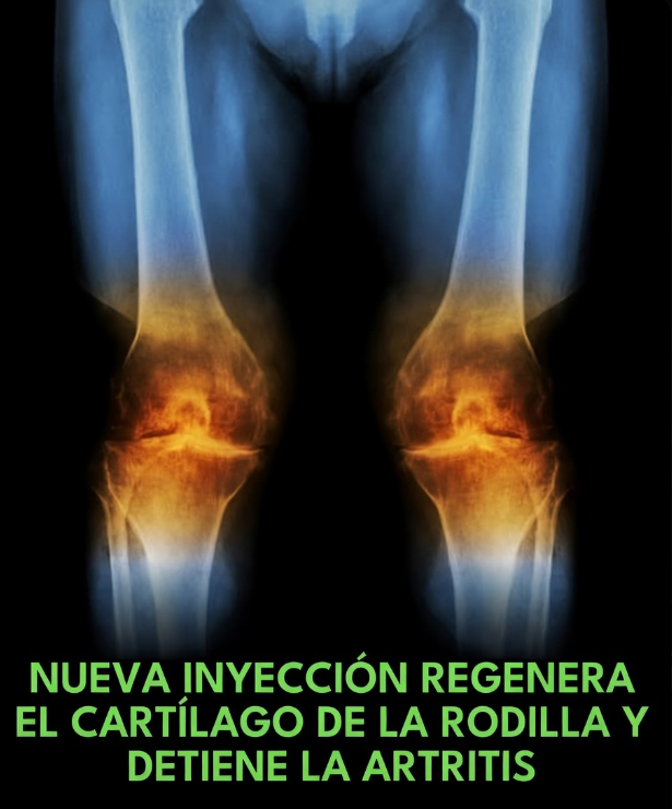 VirtudMental's tweet photo. Una nueva inyección literalmente hace que crezca nuevamente el cartílago de la rodilla.

Investigadores de Stanford Medicine han identificado una nueva estrategia para regenerar el cartílago articular de las rodillas y potencialmente prevenir o tratar la osteoartritis (OA).

El método se dirige a la 15-hidroxiprostaglandina deshidrogenasa (15-PGDH), una enzima relacionada con la edad, o "gerozima", que se acumula en los tejidos envejecidos e impulsa la degeneración.

En ratones viejos, los inhibidores de moléculas pequeñas de 15-PGDH, administrados sistémicamente o mediante inyección intraarticular, promovieron el engrosamiento del cartílago y la regeneración del cartílago articular hialino funcional.

Esto ocurrió sin reclutar células madre o progenitoras; en cambio, los condrocitos existentes experimentaron una reprogramación transcripcional a un estado juvenil, con poblaciones reducidas de células inflamatorias e hipertróficas/degradativas y condrocitos articulares productores de matriz expandidos.

Los inhibidores también revirtieron el adelgazamiento natural del cartílago relacionado con la edad, mejoraron la función articular y, cuando se administraron después de lesiones simuladas del ligamento cruzado anterior (LCA), mitigaron en gran medida la progresión de la OA postraumática y el dolor asociado.

Los explantos de cartílago OA humano provenientes de reemplazos totales de rodilla respondieron de manera similar in vitro, mostrando marcadores de degradación disminuidos y evidencia de formación de nuevo cartílago articular.

Dado que un inhibidor oral de 15-PGDH ya ha completado los ensayos de seguridad de fase 1 para la atrofia muscular relacionada con la edad, los hallazgos abren un camino hacia terapias regenerativas modificadoras de la enfermedad que podrían retrasar o eliminar la necesidad de una cirugía de reemplazo articular.

[Agarwal, P., Su, S., Ancel, S., et al. (2025). La inhibición de la 15-hidroxiprostaglandina deshidrogenasa promueve la regeneración del cartílago. Science. DOI: 10.1126/science.adx6649]