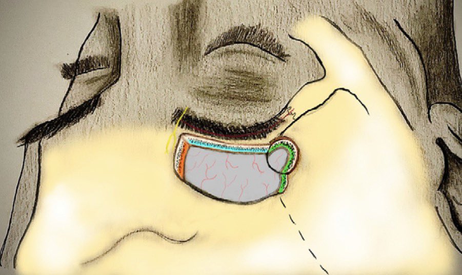 jaithakurMD's tweet photo. Honored to be invited for sharing my 2 cents on Eyebrow approach for Anterior Skull Base meningiomas @NASBSorg . Great interactive discussion with skull base collegues from Brigham and OHSU Oregon. Thank you @StephenTMagill for organizing a great educational dialogue! #meningioma https://t.co/6637fVANBA