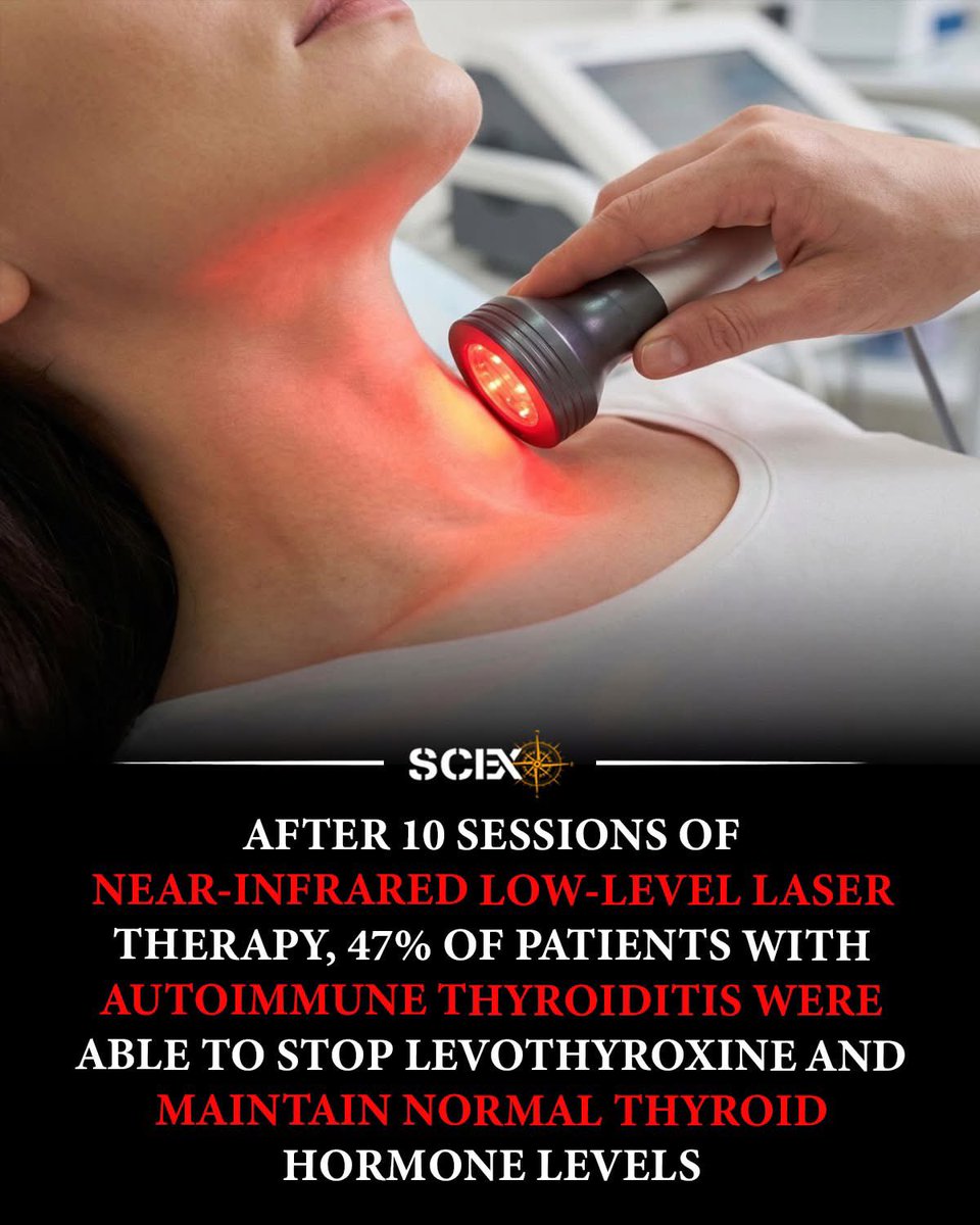 argosaki's tweet photo. 🚨 2026 Thyroid Hope: Could Light Therapy Let ~47% of Hashimoto’s Patients Drop Daily Meds? 🔦🛡️

Hashimoto’s (chronic autoimmune thyroiditis) usually means lifelong levothyroxine. 
But clinical research on low-level laser therapy (LLLT / photobiomodulation) is turning heads.
In a randomized, placebo-controlled trial:
•  Patients got 10 sessions of near-infrared laser to the thyroid area.
•  ~47% stopped levothyroxine completely → stayed off with normal thyroid levels for up to ~9-12 months.
•  The rest often needed much lower doses.
•  Benefits: lower TPO antibodies (less autoimmunity), better thyroid tissue on ultrasound, improved vascularization & mitochondrial function for cell repair.

Recent studies (2023-2025) build on this—combining LLLT with supplements shows even better results on oxidative stress, quality of life, fatigue, and thyroid volume normalization.

It’s non-invasive, painless, no side effects in trials—but not a guaranteed cure. 

Not everyone responds the same, and maintenance might be needed. 

Always under endocrinologist supervision, not at-home gadgets.

Could this shift autoimmune thyroid care? 

Science says promising, especially for reducing med dependency.

Thyroid warriors: 
Thoughts on trying photobiomodulation? 
Share below! 👇
#Hashimotos #ThyroidHealing #Photobiomodulation #RedLightTherapy #AutoimmuneThyroid #LLLT #Endocrinology #HealthBreakthrough #Science2026 #ThyroidHealth
Separate sources :
📚 Verified Sources: LLLT / Photobiomodulation for Hashimoto’s Thyroiditis
Core trial with the ~47% discontinuation stat:
•  Höfling DB et al. (2013). Low-level laser in the treatment of patients with hypothyroidism induced by chronic autoimmune thyroiditis: a randomized, placebo-controlled clinical trial. Lasers in Medical Science. https://t.co/RkRRaTuaTl (43 patients; LLLT group had major reductions in levothyroxine needs, TPOAb drop, improved function & ultrasound.)
Pilot study:
•  Höfling DB et al. (2010). Low-level laser therapy in chronic autoimmune thyroiditis: a pilot study. Lasers in Surgery and Medicine. https://t.co/YtapeiIbNj
Long-term safety:
•  Höfling DB et al. (2018). Safety and efficacy of low-level laser therapy in autoimmune thyroiditis: long-term follow-up. https://t.co/5LqrLDgRYw (PMC full: https://t.co/v3OeUcIbEV)
Recent supporting/combination research (2022-2025):
•  Review on mechanisms: https://t.co/KLxEYjv6jt (anti-inflammatory, regeneration effects)
•  2023 combo with supplements: https://t.co/ZT4kq4CNcd (better homeostasis vs supplements alone)
•  2025 thyroid volume study: https://t.co/BpuzAuBUr3 (PBM + supplements normalized volume more effectively)
•  Ongoing trial example: NCT06735040 (photobiomodulation on fatigue/behavior in Hashimoto’s) https://t.co/8rWBd1exrb
•  Oxidative stress/quality of life trial: NCT04754607 https://t.co/OLAkcAGCgy
Promising but still emerging—not standard care yet. 
Consult your doctor! 
Research keeps evolving. 📖 #ThyroidScience #EvidenceBasedHealth
