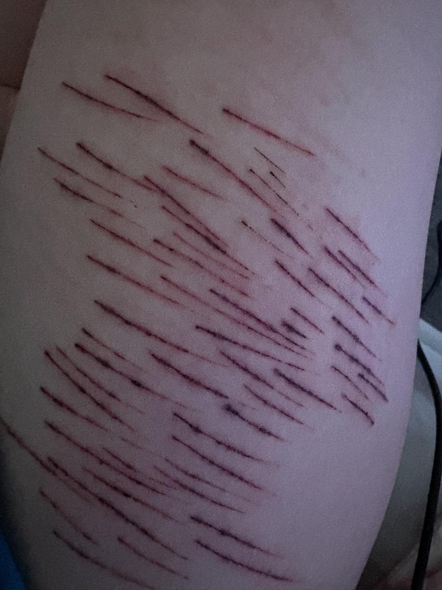 shrinky330's tweet photo. GUHHH my scabs are so dark wtf😭 #shtwt https://t.co/vUxxhHukcf