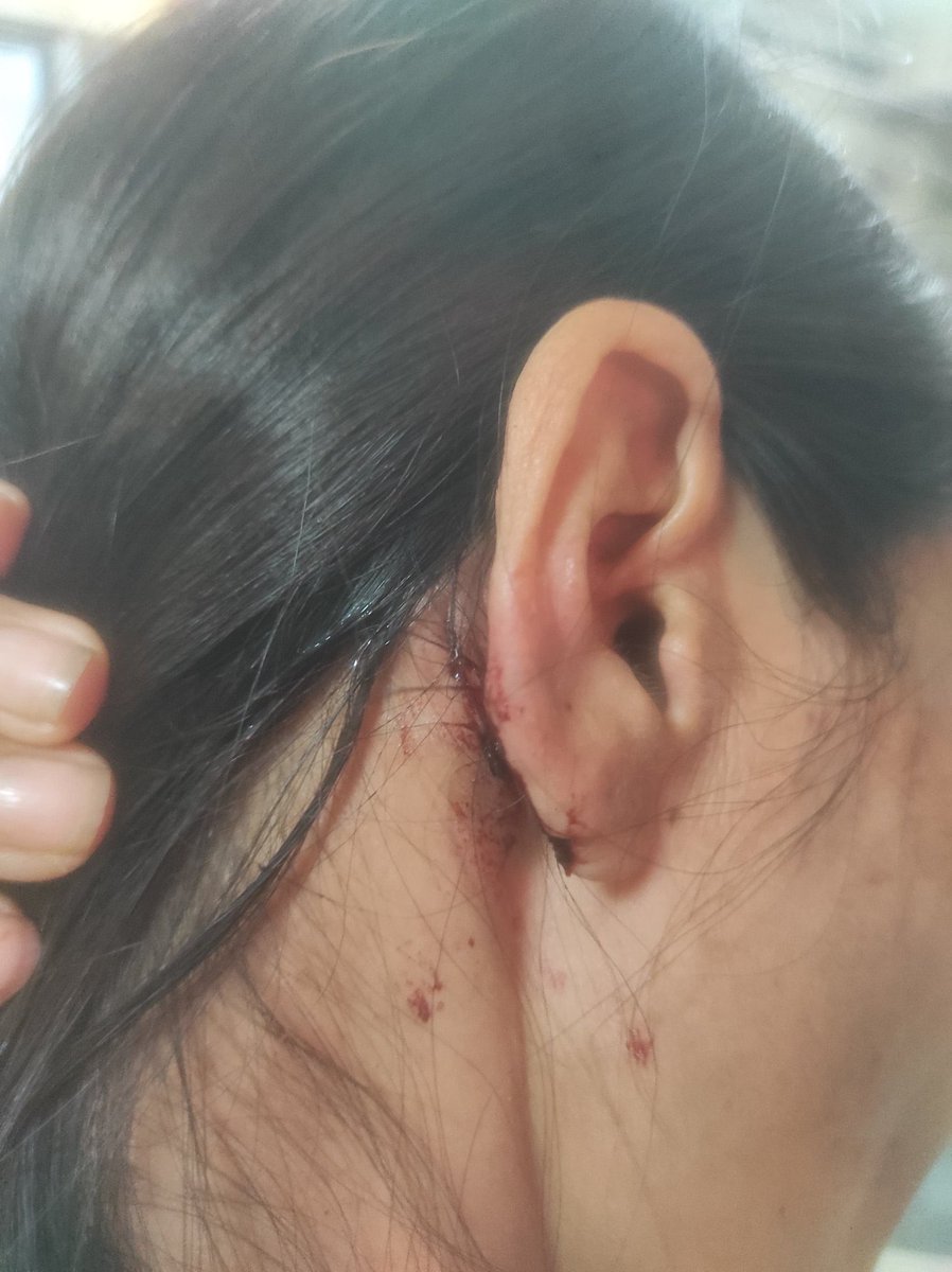 aboyobbhuyan's tweet photo. Delhi: Two Northeastern - a girl from Manipur, another from Assam were assaulted, hit by a group of boys near the Saket District Court Complex.

They reportedly went for an evening walk when they were passed derogatory, racial comments by the group of boys.

After she objected the harassment, she was physically assaulted.