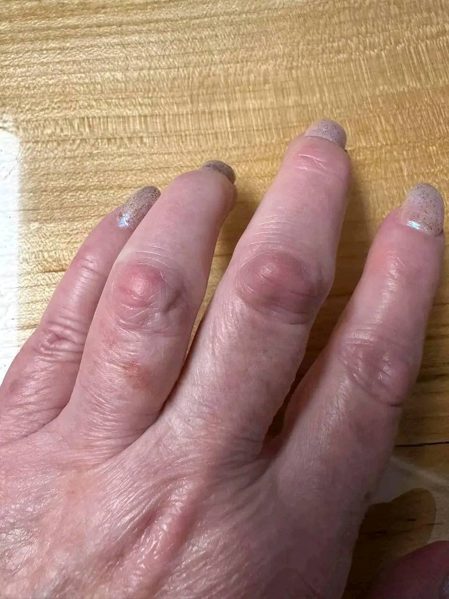 LoiCSound's tweet photo. Ivermectin and DMSO can provide substantial relief for both Rheumatoid Arthritis and Osteoarthritis!

I already have multiple testimonials, and every day, more individuals are eager to give it a try. 

You also don't require a large dose. https://t.co/0kvz080fMW