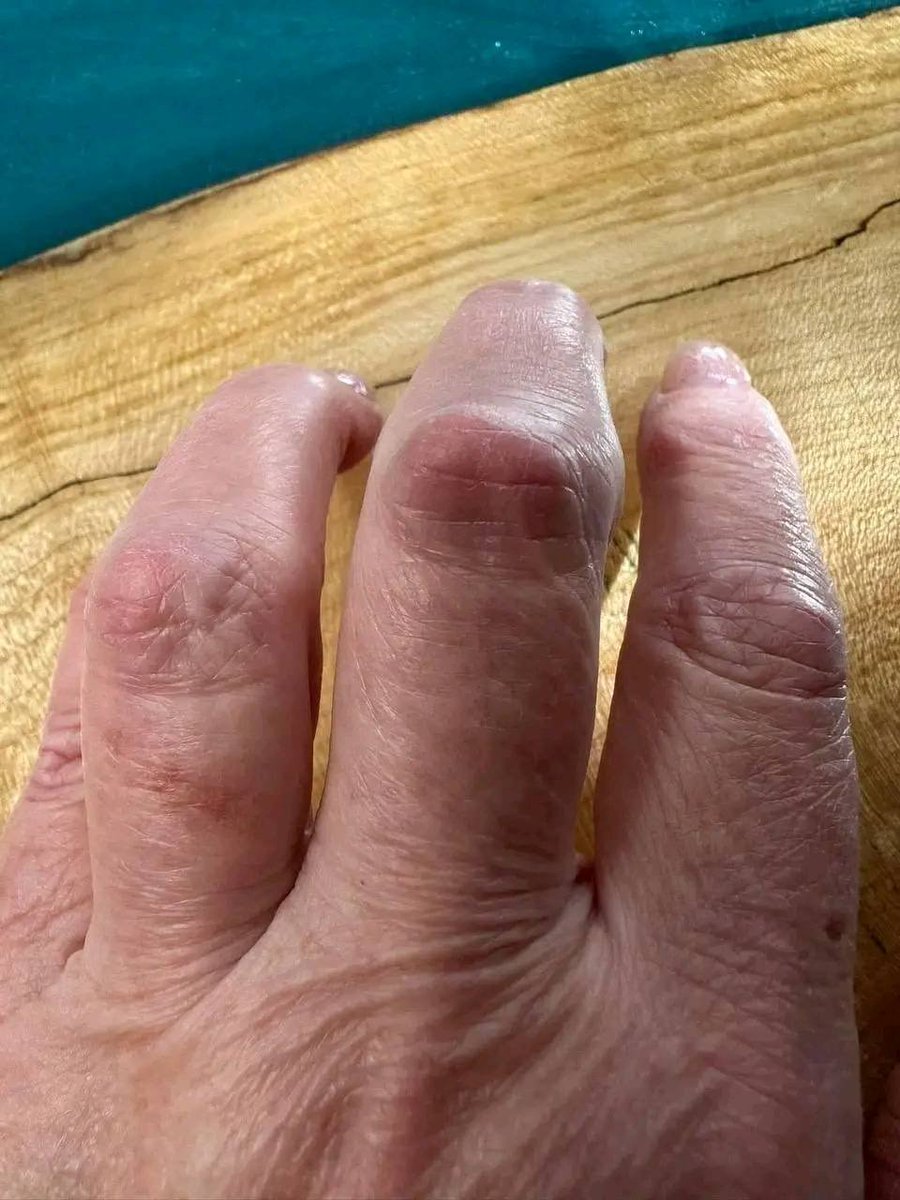 LoiCSound's tweet photo. Ivermectin and DMSO can provide substantial relief for both Rheumatoid Arthritis and Osteoarthritis!

I already have multiple testimonials, and every day, more individuals are eager to give it a try. 

You also don't require a large dose. https://t.co/0kvz080fMW