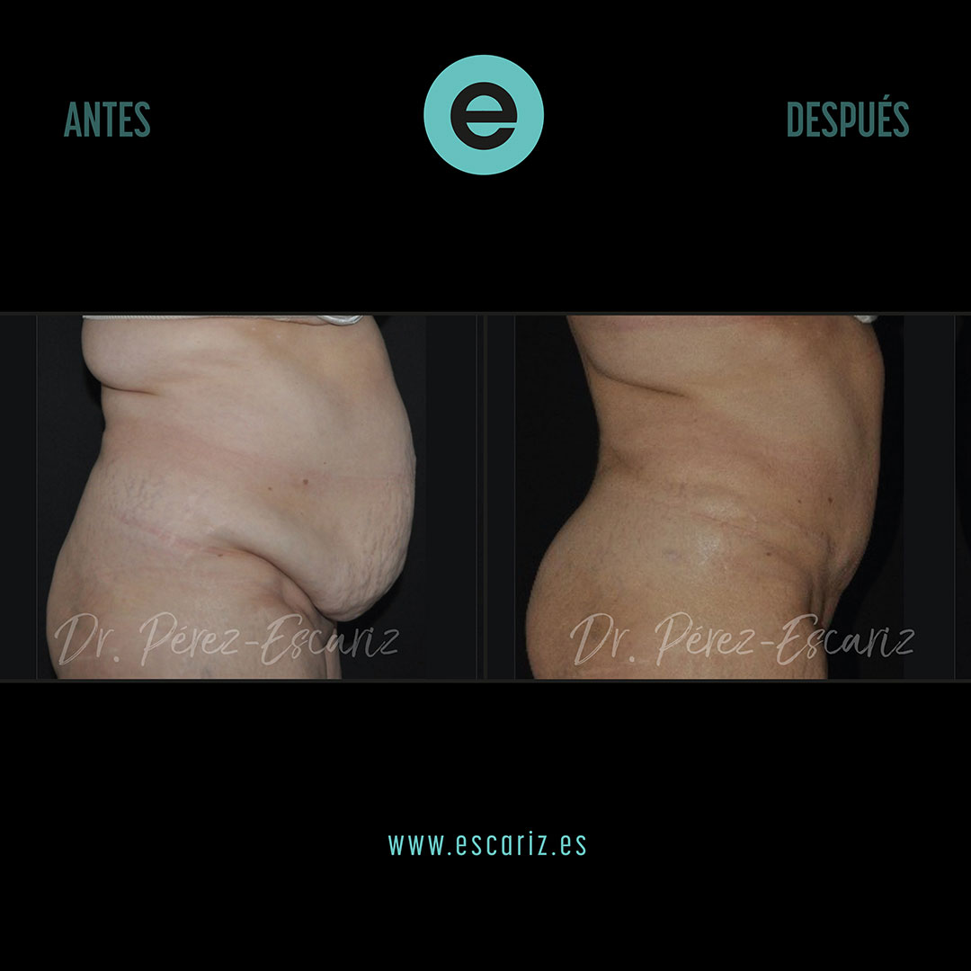 DrPerezEscariz's tweet photo. Nos alegra que nuestra paciente tras la lipo-abdominoplastia 360° con injertos en glúteos, corrección de hernia umbilical y diástasis abdominal haya logrado un abdomen firme, mejorando molestias de espalda y su calidad de vida.
#liposucción #abdominoplastia https://t.co/4RJ0JKOFMs