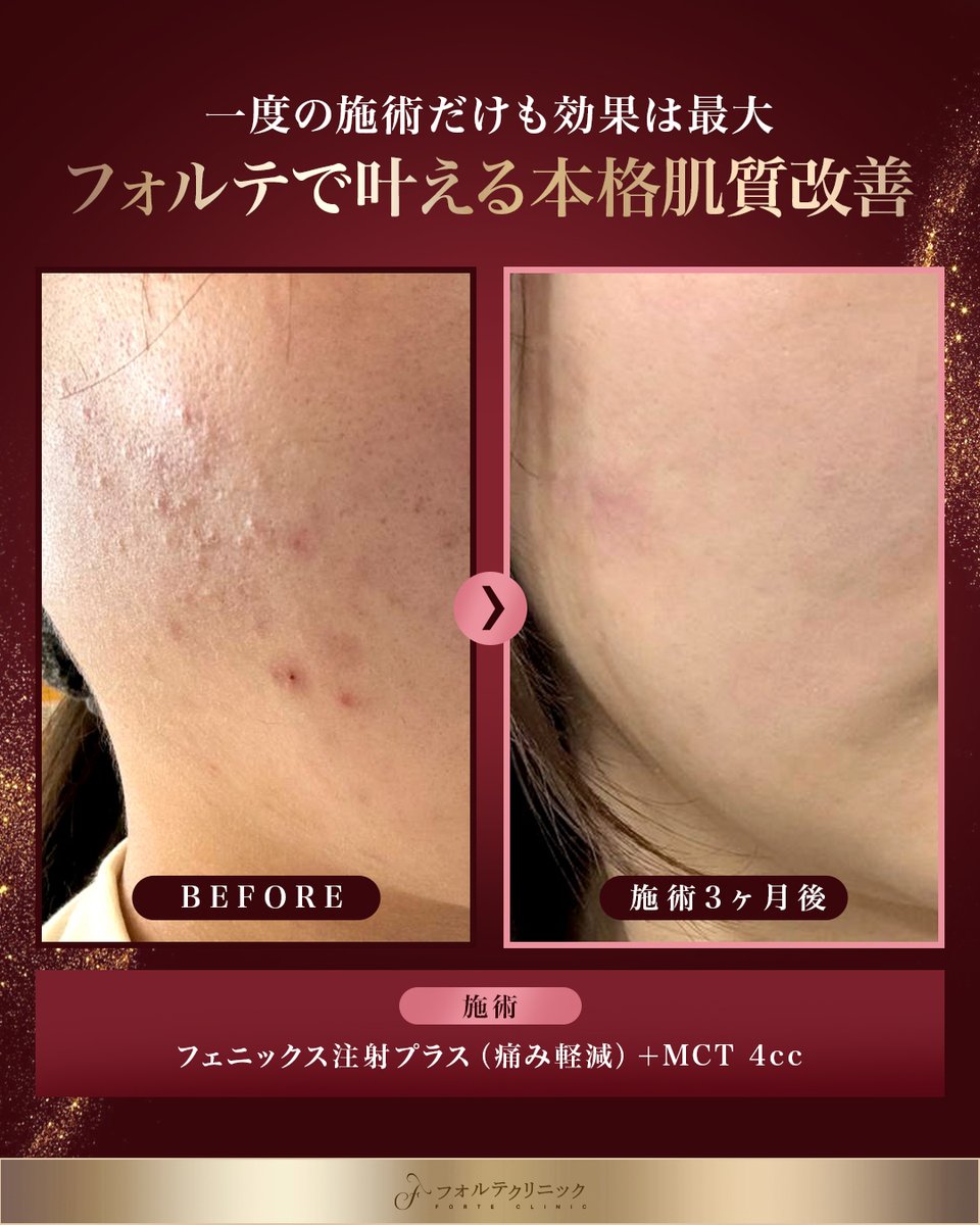 forteclinicjpn's tweet photo. ◤リポストで豪華施術をGET🎁◢

95万ウォン相当✨
フェニックス注射プラスを抽選で3名様に贈呈🎁

■フェニックス注射プラスとは？
肌本来の再生力を引き出す本格エイジングケア🧬
従来のフェニックス注射より痛みに配慮した施術です。

＼参加方法／
✦当院アカウントをフォロー
✦本投稿をリポスト+いいね
*レポ条件

《フォルテ拡張イベント開催中》
✦人気パッケージが最大74％OFF📣
✦モバイルバッテリーやエコバッグなど
豪華トラベルバッグも配布中！

✧公式ライン 江南店✧
https://t.co/vPpylmPTyi
✧公式ライン 釜山店✧
https://t.co/4QaSRUUE6l
✧オンライン予約 江南店✧
https://t.co/sKarUoqmcu