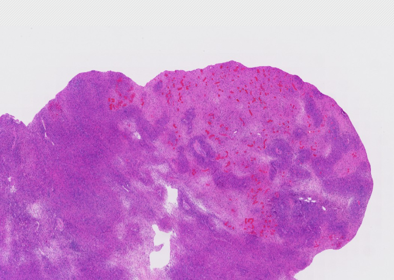 Janiranavarro's tweet photo. EBV-associated smooth muscle tumor  
12yo F s/p allogenic BMT with 2 cm intra-abdominal mass

Occurs in 3 main settings:  
- HIV/AIDS immunodeficiency: CNS predilection  
- Post solid organ/stem cell transplant immunodeficiency: liver, lung, GI tract most common  
- Congenital/primary immunodeficiency  

🔬 Spindled cells, ample eosinophilic cytoplasm, intersecting fascicles. Mild–moderate nuclear atypia (can be marked); HIV cases often ↑ mitoses ± necrosis. Common intratumoral T-cell infiltrate.  

IHC: + desmin, h-caldesmon, SMA, EBER  

Tip: In immunosuppressed patients with smooth muscle neoplasm → consider EBV-SMT & order EBER ISH  

Dr. Lauer - Tips & Hints in Surgical Pathology #USCAP #pathology #PathX