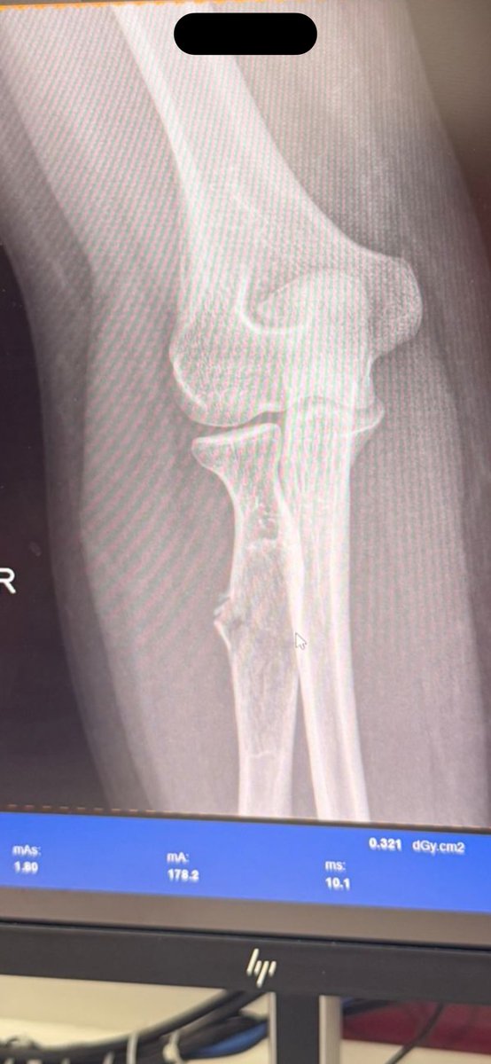 اخ يا كرة القدم ثالث اصابة في اليد