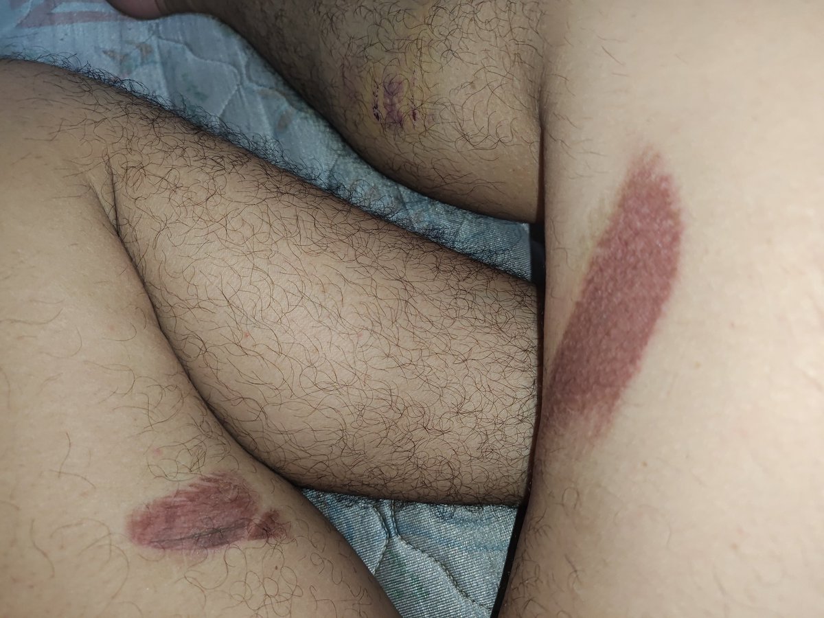 Sebelum puasa kemarin kecelakaan, baru ngeh malem ini, "gue kynya ditegor ma Tuhan deh krn kebiasaan kalo keluar rumah make celana pendek, pdhl d atas lutut kan aurat". 

Hikmah yg dipetik selama bulan Ramadhan sejauh ini.

#Ramadhan1447H