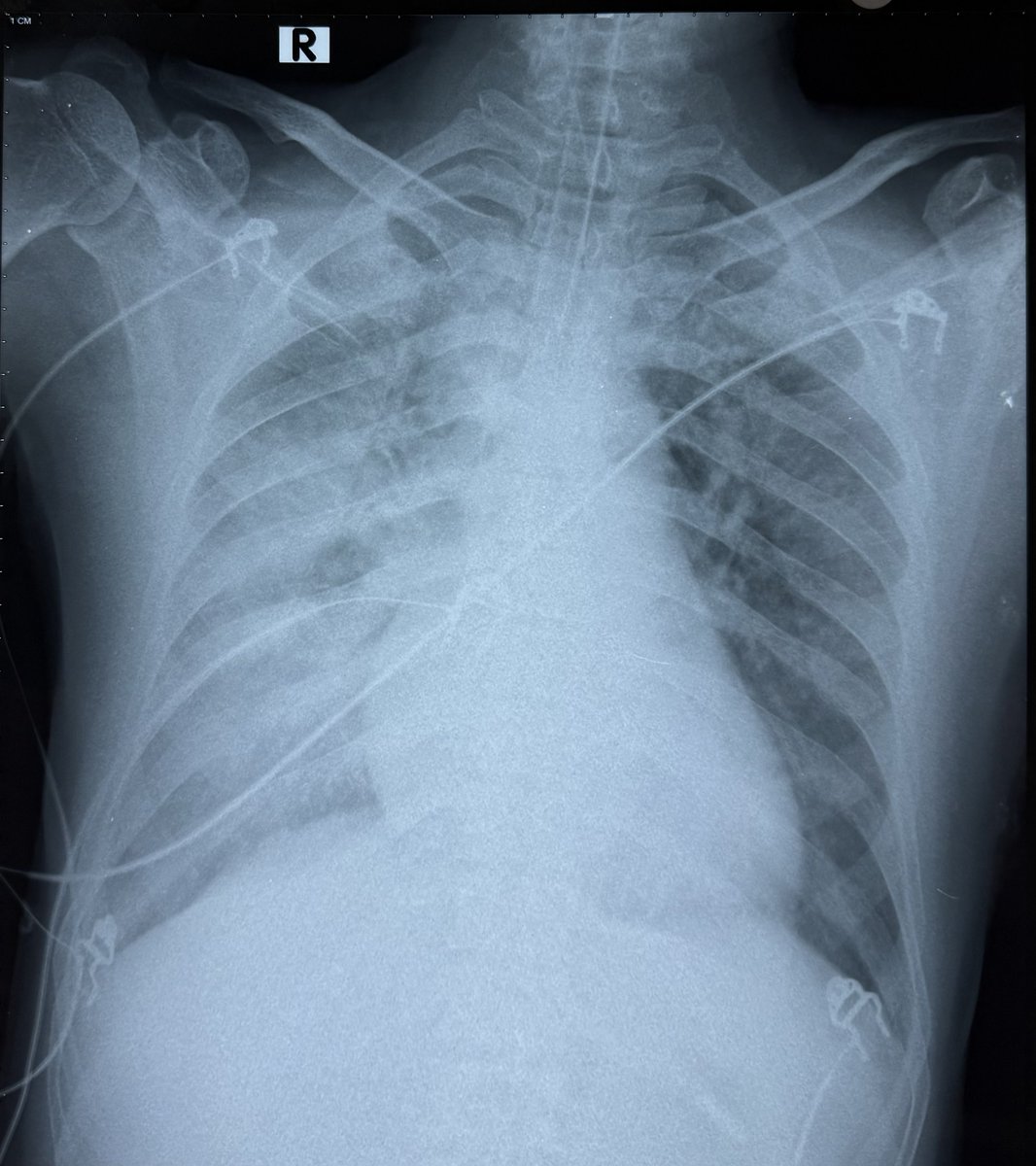 DrRajeshG1's tweet photo. X ray for residents and fellows. Dyspnoea following retrosternal pain of half hour duration. Why pulmonary oedema more on right side? https://t.co/Zy4AkRdnN5