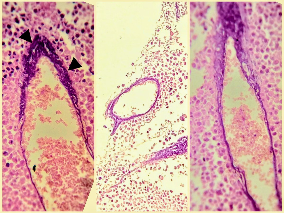 _Wondweson64's tweet photo. 🧾A patient with 👾 Small Cell Neuroendocrine Carcinoma (SCNEC).
❶ Do You Know this "EFFECT"😎?
❷ HOW it happens🤔?
❸ What are commonest CANCERS associated with it🤷♂️?
#pathx #pathtweeter #pathresidents #pathology https://t.co/TWzWVQir5e