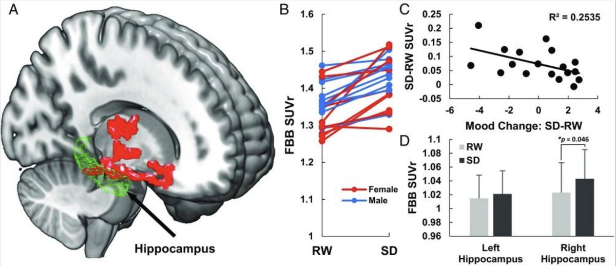 One night of sleep deprivation increased β-amyloid (metabolic waste linked to Alzheimer's disease) burden by ~5%.

Higher amyloid spikes also correlated with worse mood.