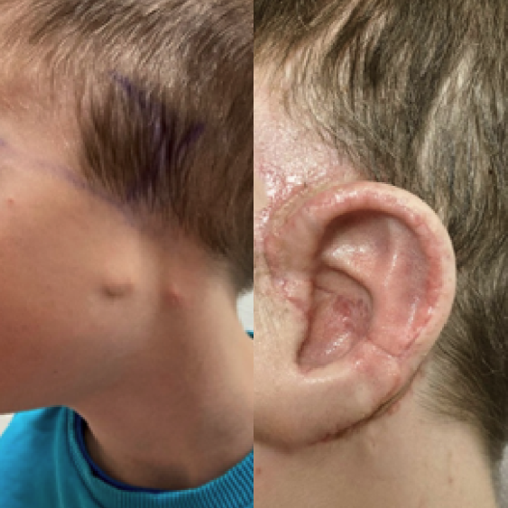 🇫🇷 Le CHU de Lille reconstruit désormais le pavillon d’oreille des enfants nés sans grâce à une technique innovante. En une seule opération, un implant est posé pour améliorer leur qualité de vie. Cette chirurgie inédite n’est proposée que dans deux établissements en France.👂👏