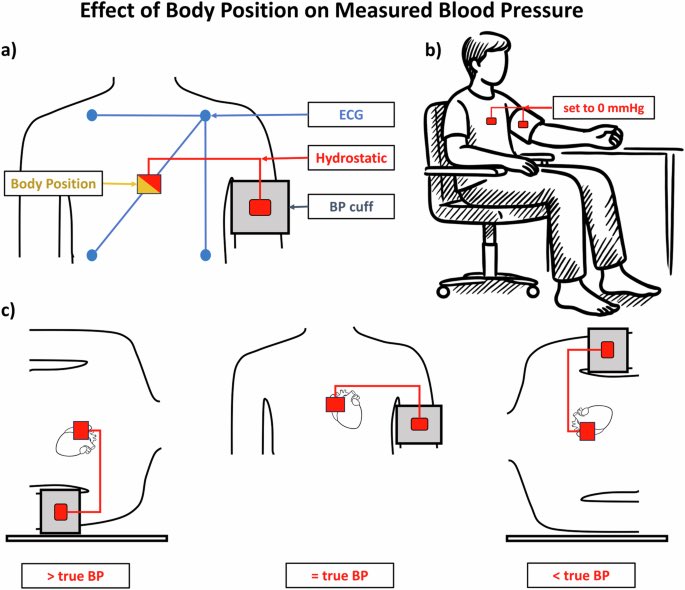 لماذا مهم جدًا الحفاظ على ضغط دم متوازن؟
ضغط الدم مهم جدًا لأنه قوة دفع الدم داخل الشرايين، وإبقاؤه ضمن الحدود الطبيعية (عادة أقل من 120/80 مم زئبق) يحمي الجسم من أضرار خطيرة.

باختصار، الحفاظ عليه طبيعيًا يقلل بشكل كبير خطر:

- النوبة القلبية (احتشاء عضلة القلب)
- السكتة