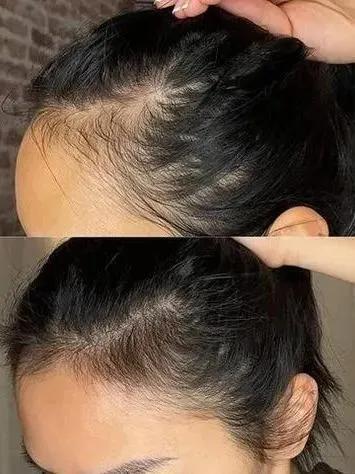 Daniela6071959's tweet photo. Fui na dermato porque meu cabelo estava caindo horrores e ela me receitou essa vitamina aqui. Gente, é surreal! O cabelo não só parou de cair como está nascendo um monte de fio novo. Sério, mudou minha vida! ✨ https://t.co/G22RjGSz74