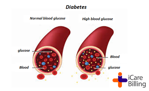 icarebilling's tweet photo. Diabetes is a chronic disease where the body doesn't produce enough insulin or can't properly use the insulin it produces, leading to high blood. Diabetes mellitus (DM) is a disease of inadequate control of blood levels of glucose.            
#icarebilling, the best #RCM Company https://t.co/U9ug8XIItS