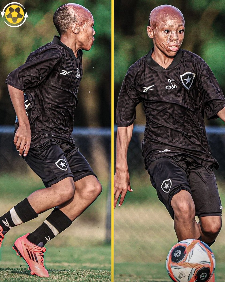 🚨 Meet one of Botafogo’s recent academy signings, Bernardo Lopes. 🇧🇷

When he was just one year old, he suffered a devastating accident — a pot of boiling water fell onto his face. Miraculously, he survived after spending seven months in hospital. 🙌

Through it all, he refused