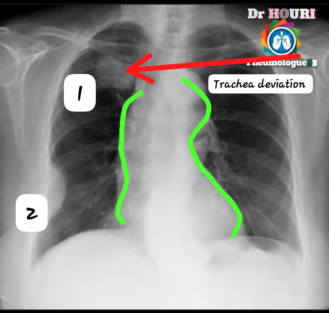 <a href="/albertoortegana/">C.Alberto Ortega</a> <a href="/dr_manish_ydv/">अहिरावण</a> [1]There is upper mass at the upper right quadrat lobe + hx of smoking 🚬 + weight loss
[Green]midesternal widening +[green]arbitration of heart boundaries +trachea deviation towards theRight sided

Dx- pulmonary 🫁 Carcinoma/ Mass 2/2 To carcinogenic substance exposure 
Ddx2:PE